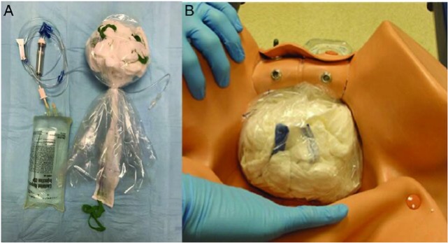 Pruebas invasivas (amniocentesis + biopsia corial)